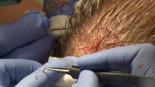 Anthony Bared MD – What is the difference between FUT & FUE ?