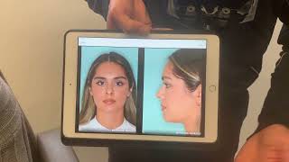 Female hispanic rhinoplasty techniques to refine tip