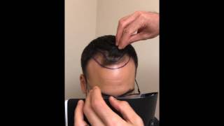 Hair transplant for hairline lowering in a 37 yo male