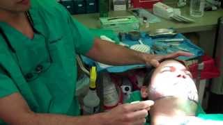 Hair Transplant Miami: Beard Hair Transplantation – Part 1