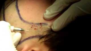 Hair Transplant Miami: Beard Hair Transplantation – Part 2