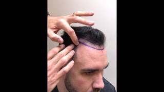 Key points for natural results in men’s hairline transplantation