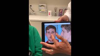 Male rhinoplasty for the tension nose