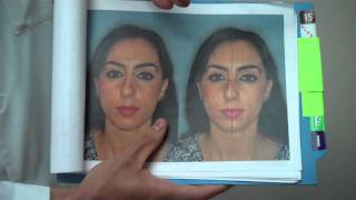 Miami Rhinoplasty: Crooked Nose and Hump Reduction