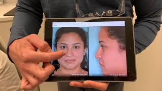 Nostril flare reduction and tip refinements in Hispanic female rhinoplasty