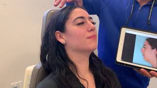 Profile alignment with hump reduction in female patient