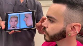 Refinements to Tip and Bridge Aesthetics in Male Rhinoplasty