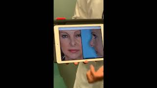 Revision Rhinoplasty for hanging tip lobule and hanging columella