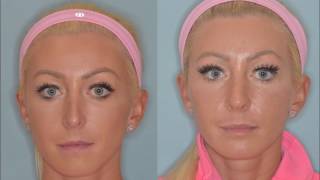 Revision rhinoplasty for the over-projected nose