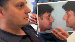 Rhinoplasty