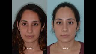 Rhinoplasty for droopy tip when smiling