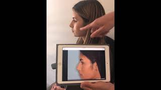 Rhinoplasty for reducing hump and tip projection