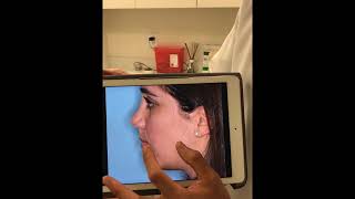 Rhinoplasty for saddle nose deformity