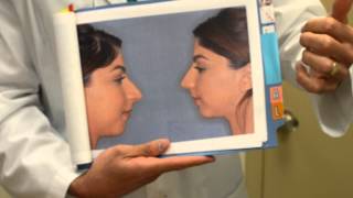 Rhinoplasty – Overprojected Nose