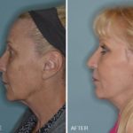 Blepharoplasty Before and After Photos in Miami, FL, Patient 1201