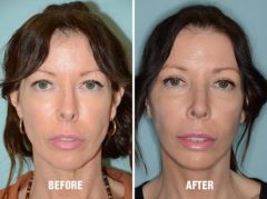 Blepharoplasty Before and After Photos in Miami, FL, Patient 1214