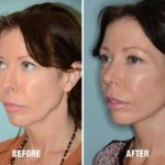 Blepharoplasty Before and After Photos in Miami, FL, Patient 1214