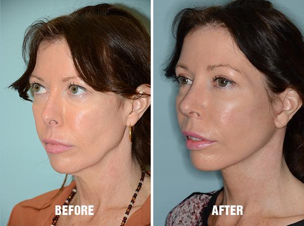 Blepharoplasty Before and After Photos in Miami, FL, Patient 1214