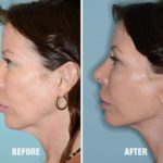 Blepharoplasty Before and After Photos in Miami, FL, Patient 1214