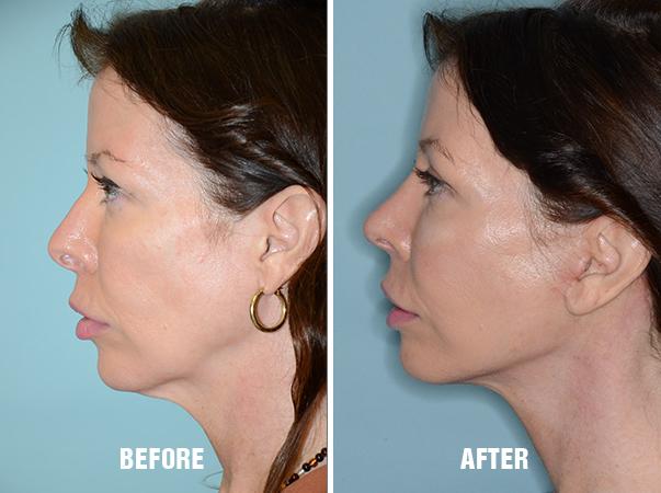 Blepharoplasty Before and After Photos in Miami, FL, Patient 1214