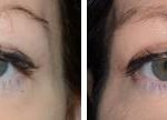 Blepharoplasty Before and After Photos in Miami, FL, Patient 1214