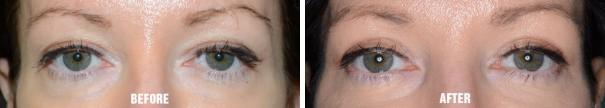 Blepharoplasty Before and After Photos in Miami, FL, Patient 1214