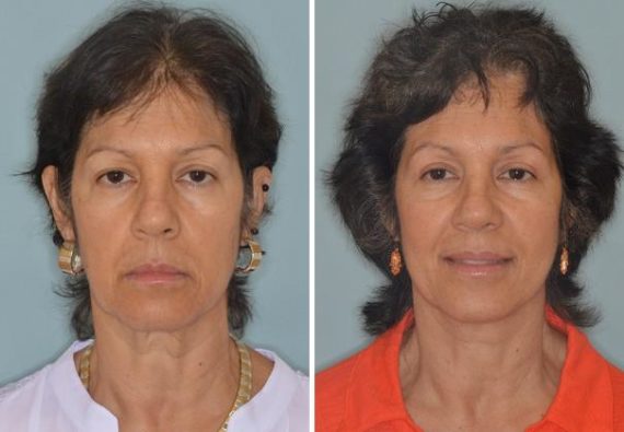 Blepharoplasty Before and After Photos in Miami, FL, Patient 1260