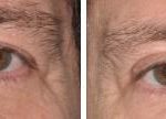 Blepharoplasty Before and After Photos in Miami, FL, Patient 1423