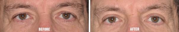 Blepharoplasty Before and After Photos in Miami, FL, Patient 1423