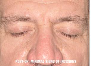 Blepharoplasty Before and After Photos in Miami, FL, Patient 1423