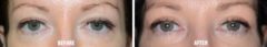 Blepharoplasty Before and After Photos in Miami, FL, Patient 1429