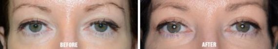 Blepharoplasty Before and After Photos in Miami, FL, Patient 1429