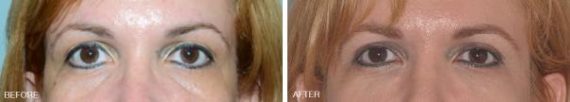 Blepharoplasty Before and After Photos in Miami, FL, Patient 1433