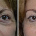 Blepharoplasty Before and After Photos in Miami, FL, Patient 1437