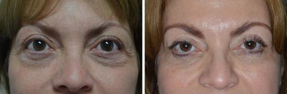 Blepharoplasty Before and After Photos in Miami, FL, Patient 1437