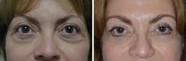 Blepharoplasty Before and After Photos in Miami, FL, Patient 1437