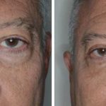 Blepharoplasty Before and After Photos in Miami, FL, Patient 1441