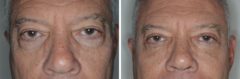 Blepharoplasty Before and After Photos in Miami, FL, Patient 1441