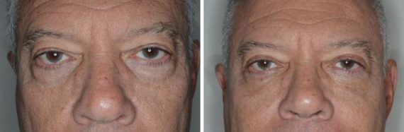 Blepharoplasty Before and After Photos in Miami, FL, Patient 1441