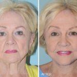 Facelift Before and After Photos in Miami, FL, Patient 1191