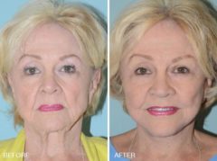 Facelift Before and After Photos in Miami, FL, Patient 1191