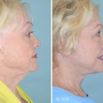Facelift Before and After Photos in Miami, FL, Patient 1191
