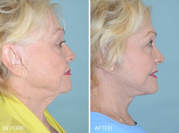 Facelift Before and After Photos in Miami, FL, Patient 1191