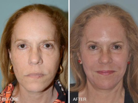 Blepharoplasty Before and After Photos in Miami, FL, Patient 1178