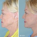 Facelift Before and After Photos in Miami, FL, Patient 1191