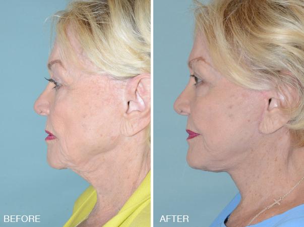 Facelift Before and After Photos in Miami, FL, Patient 1191