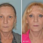 Blepharoplasty Before and After Photos in Miami, FL, Patient 1201