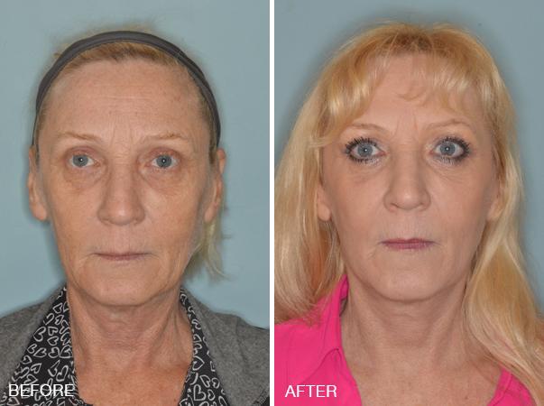 Blepharoplasty Before and After Photos in Miami, FL, Patient 1201