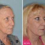 Blepharoplasty Before and After Photos in Miami, FL, Patient 1201