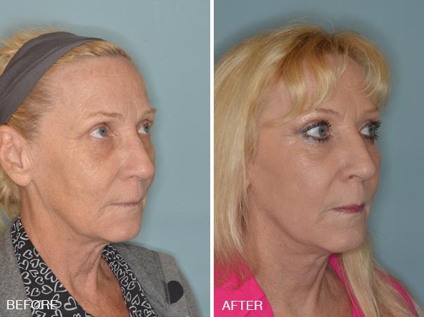 Blepharoplasty Before and After Photos in Miami, FL, Patient 1201